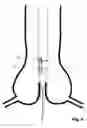 Fig. 06 - Transcatheter device for the ablation of calcified tissue at the flaps of an aortic valve