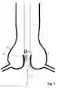 Fig. 07 - Transcatheter device for the ablation of calcified tissue at the flaps of an aortic valve