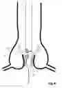 Fig. 08 - Transcatheter device for the ablation of calcified tissue at the flaps of an aortic valve