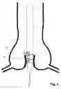 Fig. 09 - Transcatheter device for the ablation of calcified tissue at the flaps of an aortic valve