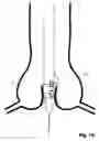 Fig. 10 - Transcatheter device for the ablation of calcified tissue at the flaps of an aortic valve