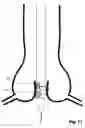 Fig. 11 - Transcatheter device for the ablation of calcified tissue at the flaps of an aortic valve