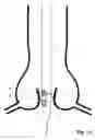 Fig. 12 - Transcatheter device for the ablation of calcified tissue at the flaps of an aortic valve