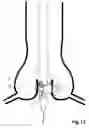 Fig. 13 - Transcatheter device for the ablation of calcified tissue at the flaps of an aortic valve