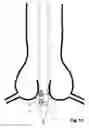 Fig. 14 - Transcatheter device for the ablation of calcified tissue at the flaps of an aortic valve