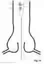 Fig. 15 - Transcatheter device for the ablation of calcified tissue at the flaps of an aortic valve