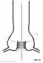 Fig. 16 - Transcatheter device for the ablation of calcified tissue at the flaps of an aortic valve