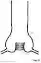 Fig. 17 - Transcatheter device for the ablation of calcified tissue at the flaps of an aortic valve