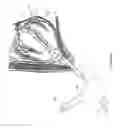 Fig. 06 - Interventional medical systems and methods for delivering a medical electrical lead to an epicardial implant site