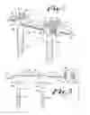 Fig. 02 - Dynamic Spinal Stabilization Assembly with Elastic Bumpers and Locking Limited Travel Closure Mechanisms