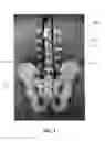 Fig. 02 - ILIAC CONNECTOR, CONNECTOR HEAD, SPINAL FIXATION SYSTEM AND METHOD OF STABILIZING A SPINE