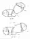 Fig. 09 - Interspinous process spacing device