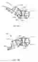 Fig. 56 - Interspinous process spacing device