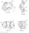 Fig. 03 - Interspinous process spacing device
