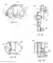 Fig. 05 - Interspinous process spacing device