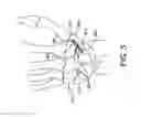 Fig. 04 - Fusion implant