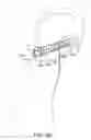 Fig. 16 - Fusion implant