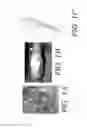Fig. 02 - Internal bone lengthener device and method of use thereof