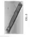 Fig. 09 - Internal bone lengthener device and method of use thereof