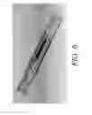 Fig. 10 - Internal bone lengthener device and method of use thereof