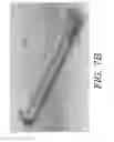 Fig. 12 - Internal bone lengthener device and method of use thereof