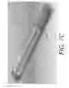 Fig. 13 - Internal bone lengthener device and method of use thereof