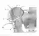 Fig. 01 - STRESS SHIELDING AND VARIABLE TENSIONING SYSTEM FOR PELVIC FRACTURE MANAGEMENT OF OSTEOPOROTIC BONES
