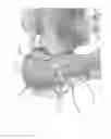 Fig. 03 - STRESS SHIELDING AND VARIABLE TENSIONING SYSTEM FOR PELVIC FRACTURE MANAGEMENT OF OSTEOPOROTIC BONES