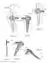 Fig. 04 - Anatomical humeral fixation system and method