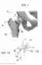 Fig. 02 - Bone fracture fixation device with transverse set screw and aiming guide