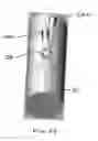 Fig. 16 - Bone fracture fixation device with transverse set screw and aiming guide