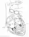 Fig. 01 - Self-centering multiray ablation catheter