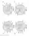 Fig. 05 - Medical device having removable deployment device and affixation element