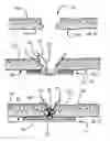Fig. 10 - Medical device having removable deployment device and affixation element