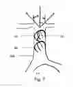 Fig. 05 - Tiltable implantable medical device