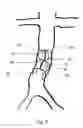 Fig. 06 - Tiltable implantable medical device