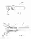 Fig. 10 - Methods of self-aligning stent grafts