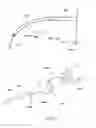 Fig. 23 - Methods of self-aligning stent grafts