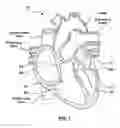 Fig. 02 - Heart valves prostheses and methods for percutaneous heart valve replacement