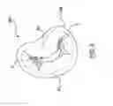 Fig. 04 - Heart valves prostheses and methods for percutaneous heart valve replacement