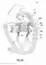 Fig. 07 - Heart valves prostheses and methods for percutaneous heart valve replacement