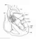 Fig. 01 - Medical guidewire