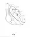 Fig. 05 - Medical guidewire