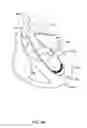 Fig. 12 - Medical guidewire