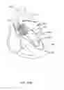 Fig. 16 - Medical guidewire