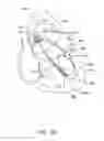 Fig. 17 - Medical guidewire