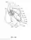 Fig. 18 - Medical guidewire