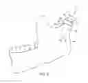 Fig. 10 - Temporomandibular joint implants and methods of treating a temporomandibular joint