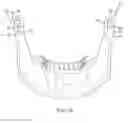 Fig. 11 - Temporomandibular joint implants and methods of treating a temporomandibular joint