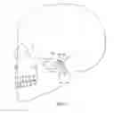 Fig. 12 - Temporomandibular joint implants and methods of treating a temporomandibular joint